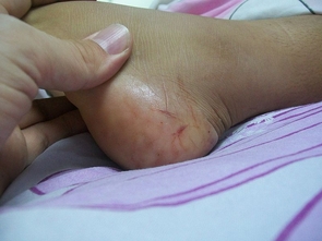 Snake bite on side of child's foot